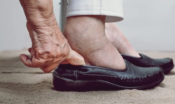 10 causes of "swollen feet"